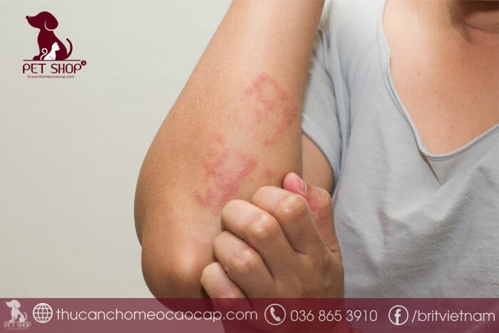 Dấu hiệu bị sán chó gồm những gì? Dấu hiệu bị sán chó gồm những gì?