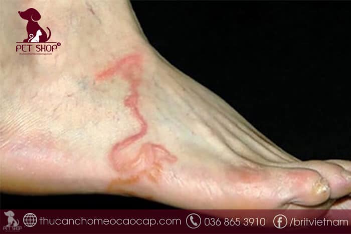 Dấu hiệu bị sán chó giai đoạn phóng thích vào máu Dấu hiệu bị sán chó giai đoạn phóng thích vào máu